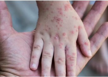 “მაიმუნის ყვავილის” ვირუსი და საქართველო